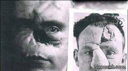 اولین کسی که بینی اش را جراحی کرد! + تصاویر