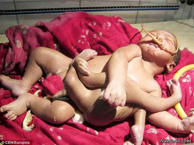 تولد نوزاد با هشت دست و پا + عکس