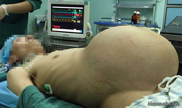 جراحی تومور | جراحی تومور 15 کیلویی در 6 ساعت + تصاویر