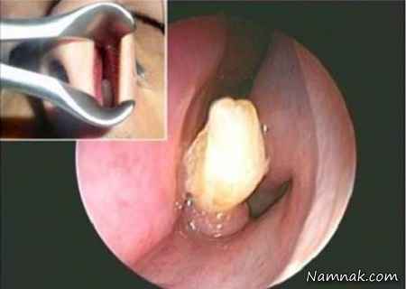 کشیدن دندان از بینی! + تصاویر