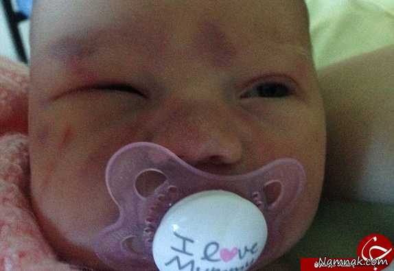 کنده شدن جمجمه نوزاد در حین زایمان! + تصاویر