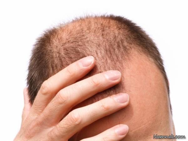 یکی از عوامل ریزش مو در مردان ژنتیک است