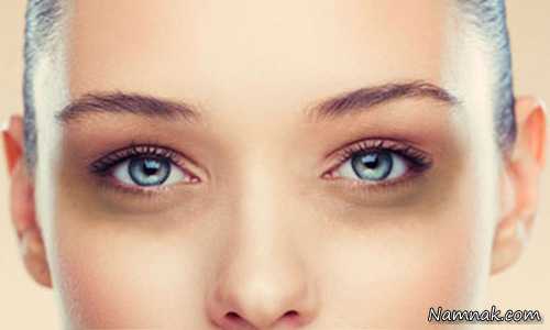 سیاهی دور چشم | درمان دائم سیاهی دور چشم