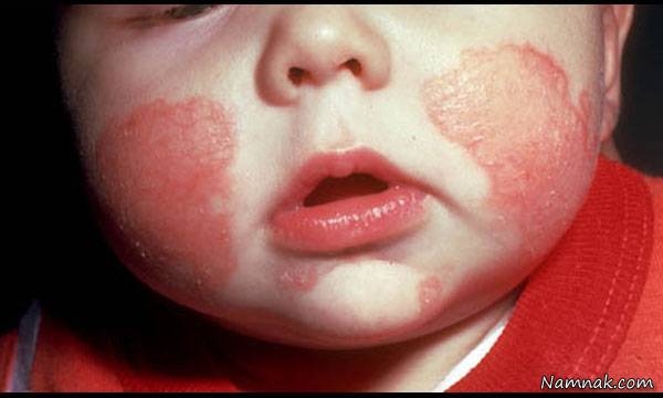 بیماری اگزمای آتوپیک در کودکان را بشناسید