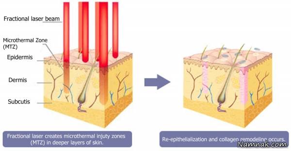 لیزر فرکشنال , بهترین درمان مشکلات پوستی و ترکهای بدن 