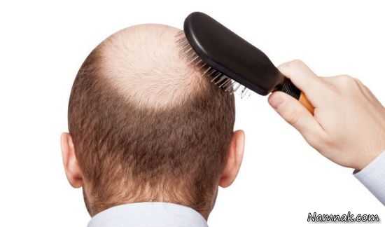 درمان ریزش مو | بهترین درمان ریزش مو و ماسک مو پرپشت کننده پیاز