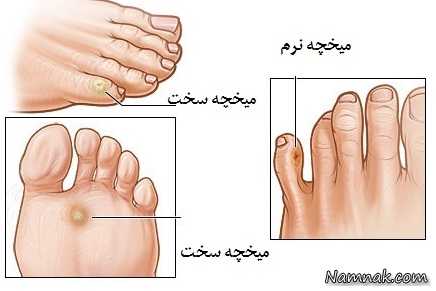 میخچه بیماری پوستی شایع در زنان