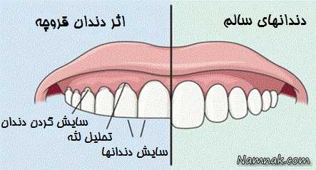 دندان قروچه و علت های آن