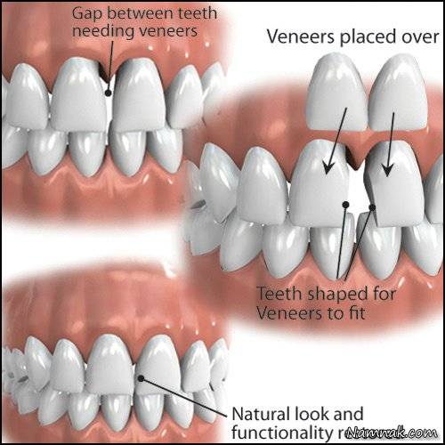 لمینت دندان , هرچه که باید از کامپوزیت و ونیز بدانید