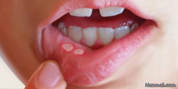 آفت های دهان چه زمانی نشان دهنده ی سرطان دهان است؟