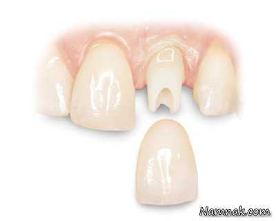 پروتز دندان | آشنایی کامل با انواع “پروتز دندان”