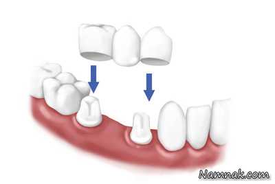 پروتز دندان | آشنایی کامل با انواع “پروتز دندان”