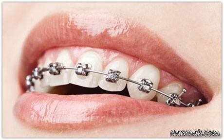 در طول ارتودنسی دندان این خوراکی ها را نخورید