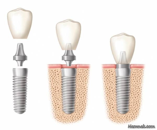 ایمپلنت کاشت دندان , همه چیز درباره بریج دندانی خوب