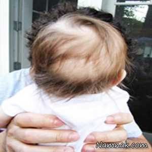 علت و درمان ریزش مو در کودکان