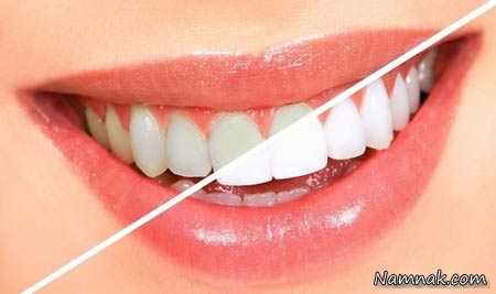 سفید شدن دندان | سریعترین روش “سفید شدن دندان” درخانه با مواد طبیعی
