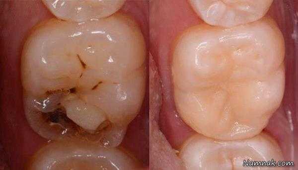 این عادت اشتباه دلیل پوسیدگی دندان شماست!