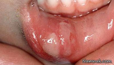 عوامل ودرمان موثر در ایجاد آفت دهانی