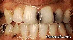 رابطه پرخوری عصبی با پوسیدگی دندان ها