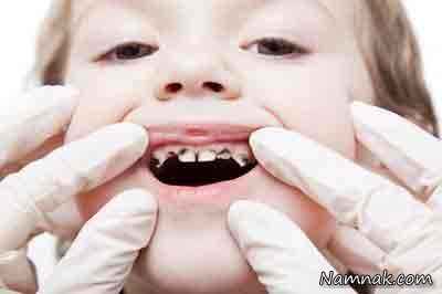 پوسیدگی دندان شیرخواران چگونه اتفاق می افتد؟