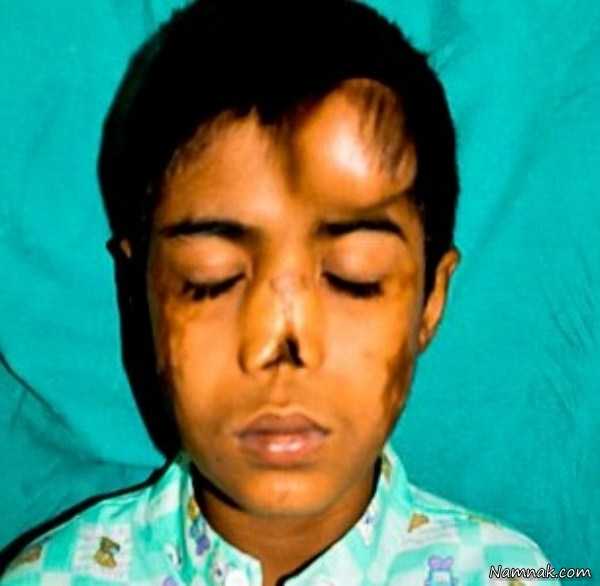 پیوند بینی | کاشت و پیوند بینی پسربچه هندی بعد از 12 سال