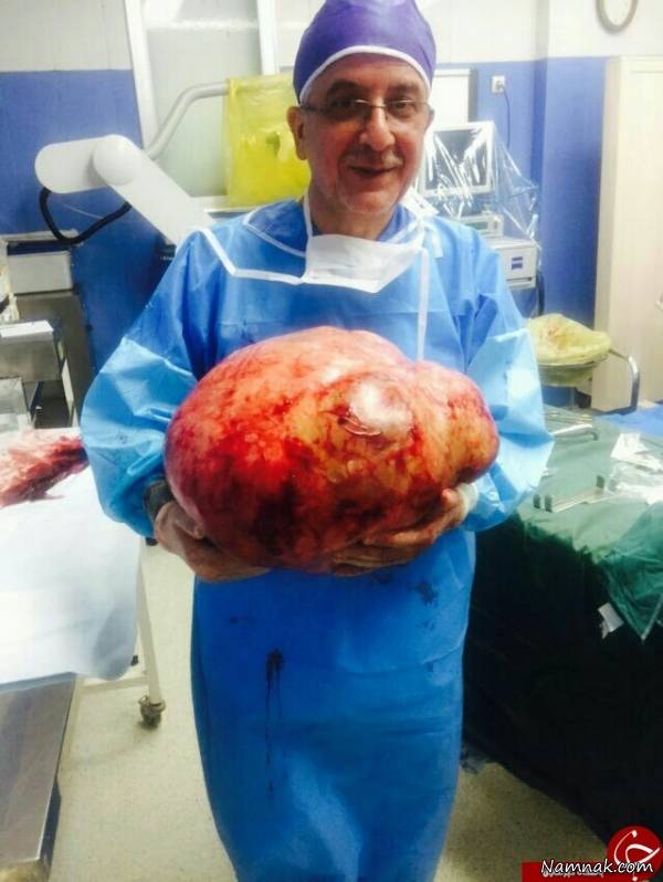 جراحی نادر تومور 20 کیلویی در مشهد + عکس