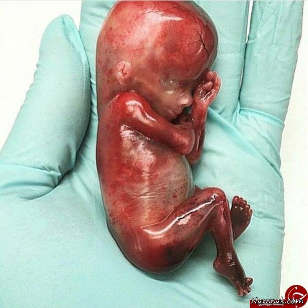عکس جنین سقط شده 19 هفته ای در دستان پزشک
