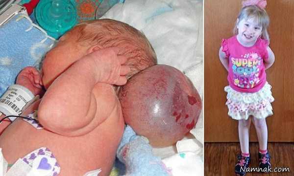 تولد نوزاد دو سر به دلیل ضایعه جمجمه + تصاویر