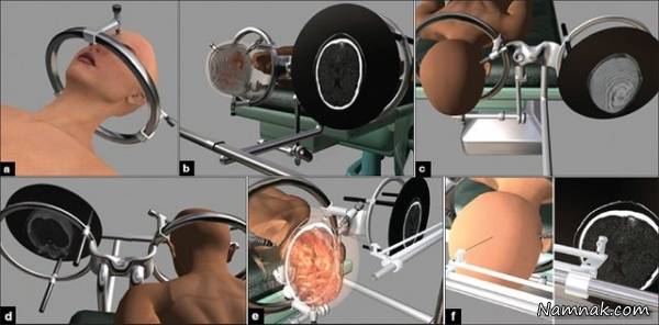 جراحی تومور مغزی با روش کم تهاجمی + تصاویر