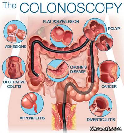 نکاتی که قبل از آزمایش کولونوسکوپی باید رعایت کنید