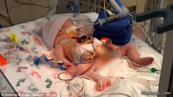 قلب بیرون سینه , جراحی نوزاد کردیا توسط 60 پزشک