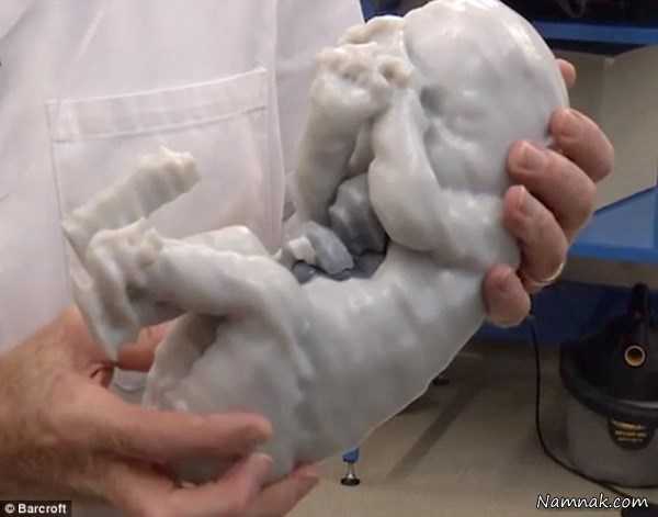 قلب بیرون سینه , جراحی نوزاد کردیا توسط 60 پزشک