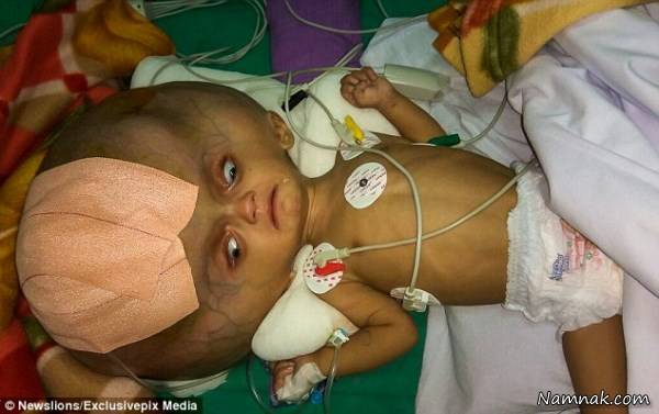 تصاویر جراحی نوزادی با بزرگترین سر دنیا