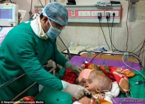 تصاویر جراحی نوزادی با بزرگترین سر دنیا