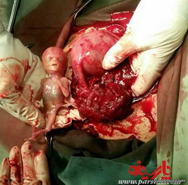 عکس جنین بارداری خارج از رحم 18+