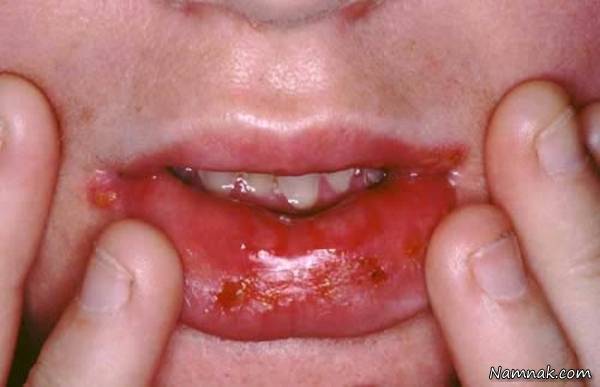 عوارض جانبی داروها بر روی دهان
