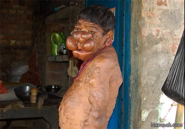 تومور , بدن پسر هندی با 300 تومور محاصره شد +عکس
