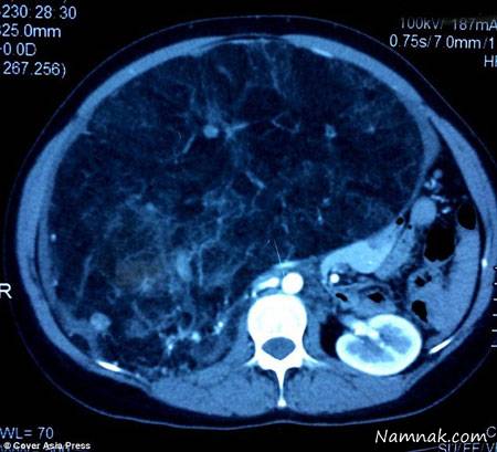 جراحی تومور 7 کیلویی از کلیه یک زن هندی + تصاویر