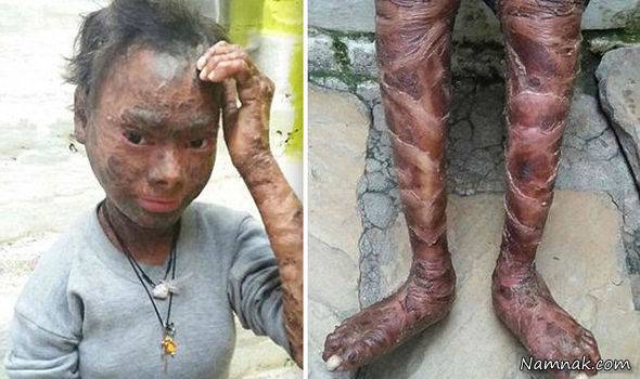 زندگی دردناک دختری با بیماری پوست ماری + تصاویر