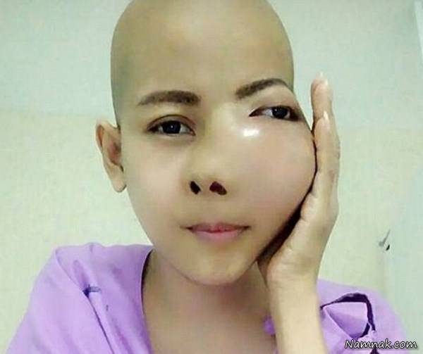 تومور دهان , آبسه لثه دختر جوان تومور سرطانی ازآب درآمد
