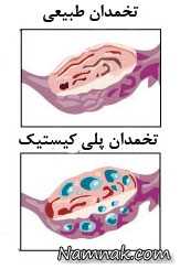 تشخیص و درمان سندروم تخمدان پلی کیستیک