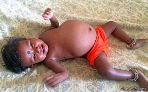 اعضای بدن جنین خواهر در شکم دختر 15 ماهه + تصاویر