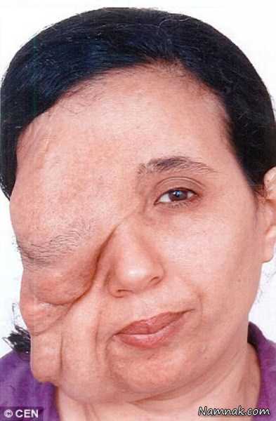 نوروفیبروماتوز چهره این زن را نابود کرده بود اما.. + تصاویر