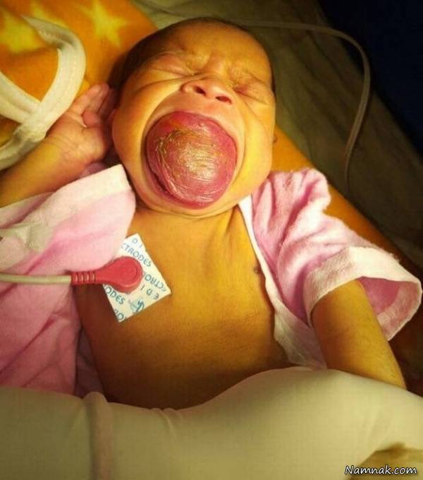 نوزادی با زبان بزرگ که هر لحظه خفه می شود + تصاویر