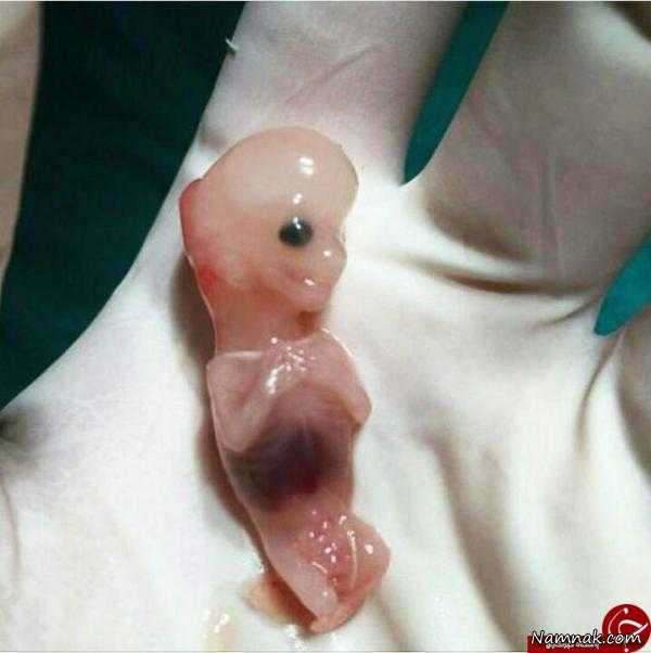 سقط جنین | تصویر دردناک سقط جنین 7 هفته ای