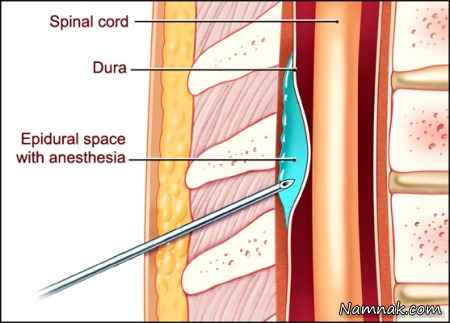 تسکین درد زایمان با بی حسی اپیدورال