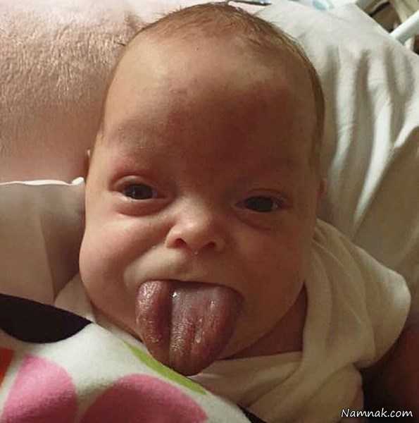 تولد نوزادی با زبانی 2 برابر بزرگ تر از زبان پدرش + عکس