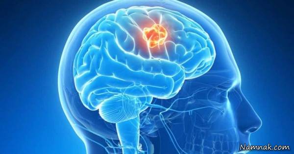 ماده شفابخش جدیدی برای درمان تومور مغزی کشف شد