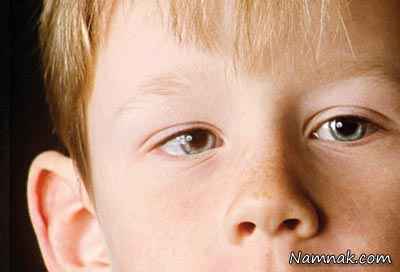 درمان انحراف چشم در هر سنی ممکن است