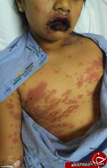 بیماری عجیب پوستی که بدن دختر 9ساله را خورد + تصاویر+18